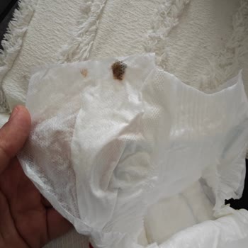 Molfix Bezlerinde Koyu Lekeler Prematüre Bebeği Endişelendirdi Ve Şirket Yanıtı Yetersiz