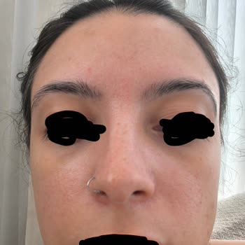 Watsons Kağıt Maskesinin Ciltte Yanma Ve Uzun Süreli Kızarıklığa Sebep Olması