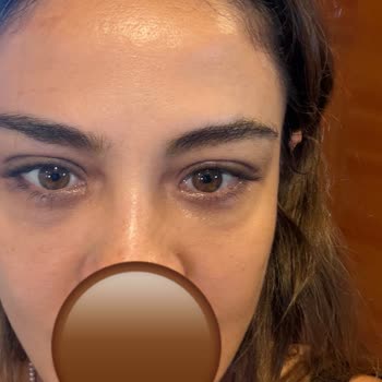 FDA Onayı Olmayan Göz Altı Enjeksiyonu Nedeniyle Mağduriyet Ve İade Talebi