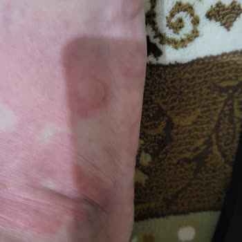 Crocs Mary Jane Owner Requests Model Exchange After Workplace Foot Injury