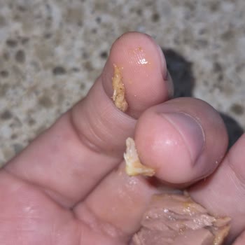 Ton Balığı Konservesinde Kılçık Bulunması Diş Eti Kanamasına Neden Oldu