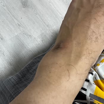 Nike Futbol Kramponunun Tabandaki Ani Kırılması Ve Sakatlık Nedeniyle Ücret İadesi Talebi