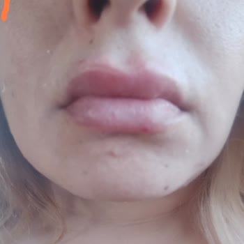 Dudak Dolgusu Sonrası Asimetri Ve Ücret İadesi Talebi