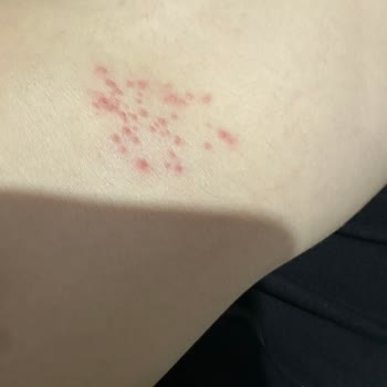Prima Bebek Bezinde Tekrarlayan Şiddetli Cilt Reaksiyonları Ve Tazminat Talebi