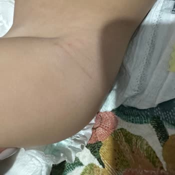 Prima Bebek Bezinde Tekrarlayan Şiddetli Cilt Reaksiyonları Ve Tazminat Talebi