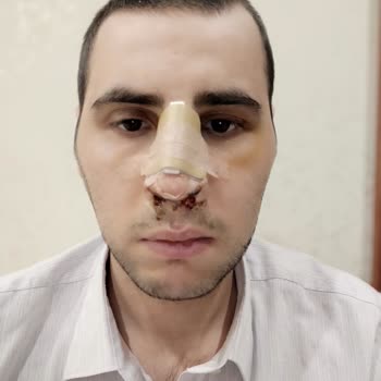 Doç. Dr. Tolga Kırgezen Burun Ameliyatı Sonrası Kıkırdak Kayması Ve Kontrol Eksikliği