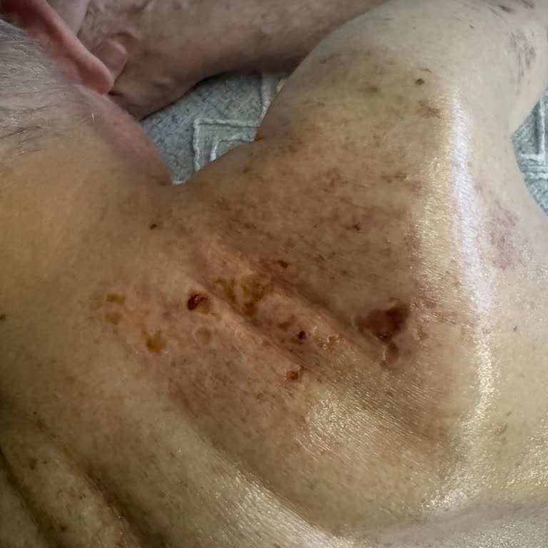 Deep Fire Masaj Jelinde Şiddetli Yanma Ve Açık Yara Oluşumu