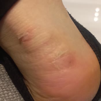 Ayak Yarasına Neden Olan Kadın Spor Ayakkabısı İçin Değişim Ve İade Talebi