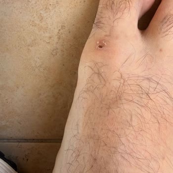 Ayakkabının Ciltte Açık Yara Bırakması Ve Tam İade Talebi