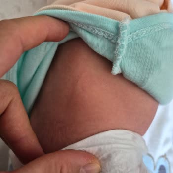 Molfix Yenidoğan Bezinin Sert Bölgesi Bebekte Cilt Tahrişi Ve Kızarıklığa Yol Açtı
