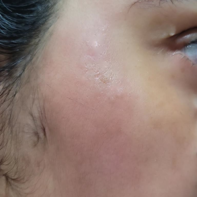 Sebamed Şampuanı Nedeniyle Şiddetli Kızarıklık Ve Yanma, İade Talebim Reddedildi