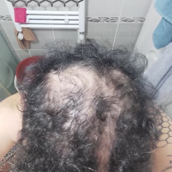 Helsa Hair Saç Ekimi Sonrası Seyrelme Ve Hijyen Sorunu İade Talebi