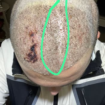 Helsa Hair Saç Ekimi Sonrası Seyrelme Ve Hijyen Sorunu İade Talebi