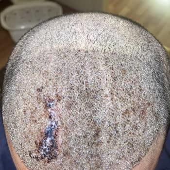 Helsa Hair Saç Ekimi Sonrası Seyrelme Ve Hijyen Sorunu İade Talebi