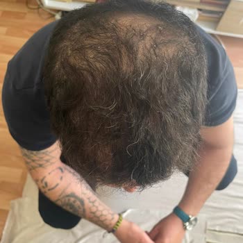 Helsa Hair Saç Ekimi Sonrası Seyrelme Ve Hijyen Sorunu İade Talebi
