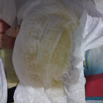 Molfix 4 Numaralı Bebek Bezlerinde Şiddetli Pişik Ve Hijyen Sorunu