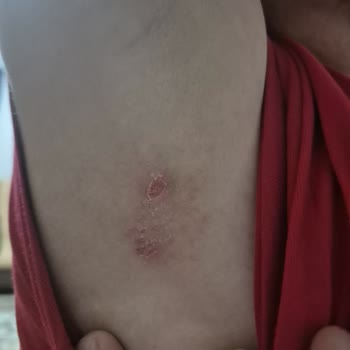 Kızımın Bikini Üzerindeki Cilt Tahrişi Ve Şirketlerin Sorumluluk Reddi
