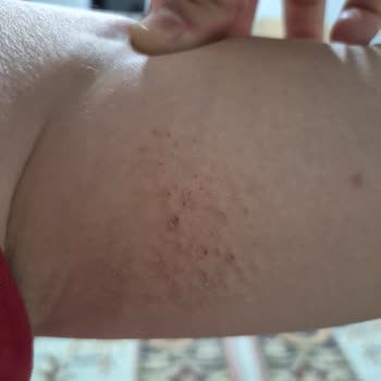 Kızımın Bikini Üzerindeki Cilt Tahrişi Ve Şirketlerin Sorumluluk Reddi