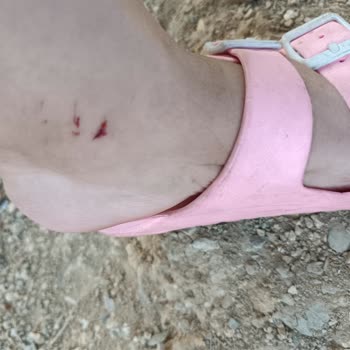 Gökçetepe Tabiat Parkında Çocukların Yaralanması Ve İade Reddi