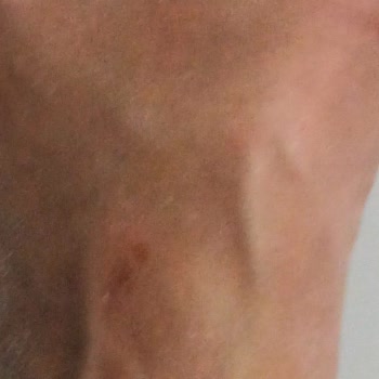 Sağlığıma Zarar Veren Deri Terlikte Yanma Ve Yara, Ücret İadesi Talebi
