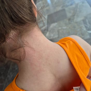 Su Kesintisi Ve Hijyen Sorunları Çocukları Hastalığa Sürükledi, İade Talebi