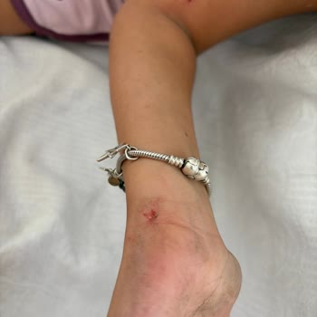 Çocuğum Scooterın Vida Sorunu Nedeniyle Ağır Yaralandı Ve Güvenlik Açığı Ortaya Çıktı