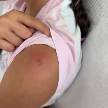 Çocuğum Scooterın Vida Sorunu Nedeniyle Ağır Yaralandı Ve Güvenlik Açığı Ortaya Çıktı