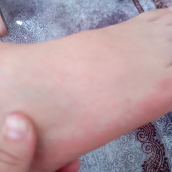 Hijyen İhmalinden Çocuğum El Ayak Ağız Hastalığına Yakalandı