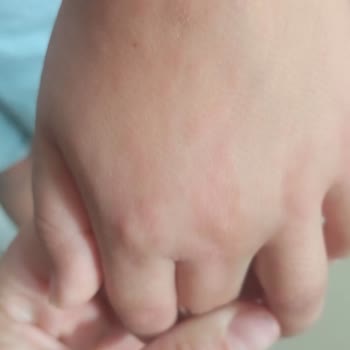 Hijyen İhmalinden Çocuğum El Ayak Ağız Hastalığına Yakalandı