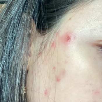 Konya Numune Hastanesi İlgisiz Davranış Ve Gecikmeli Tanı Sonucu Bulaşıcı Herpes Virüsü