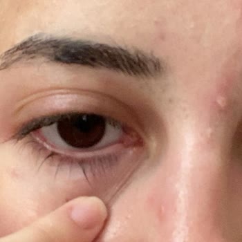 Konya Numune Hastanesi İlgisiz Davranış Ve Gecikmeli Tanı Sonucu Bulaşıcı Herpes Virüsü