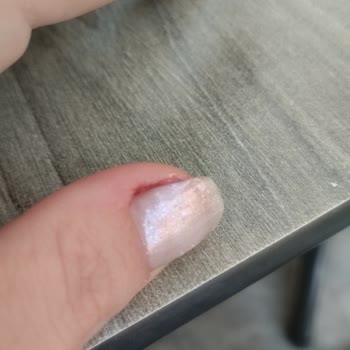 Hijyen Eksikliği Ve Ağrılı Manikür Deneyimi