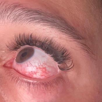 Kirpik Uygulamasında Yapıştırıcı Nedeniyle Şiddetli Göz Ağrısı