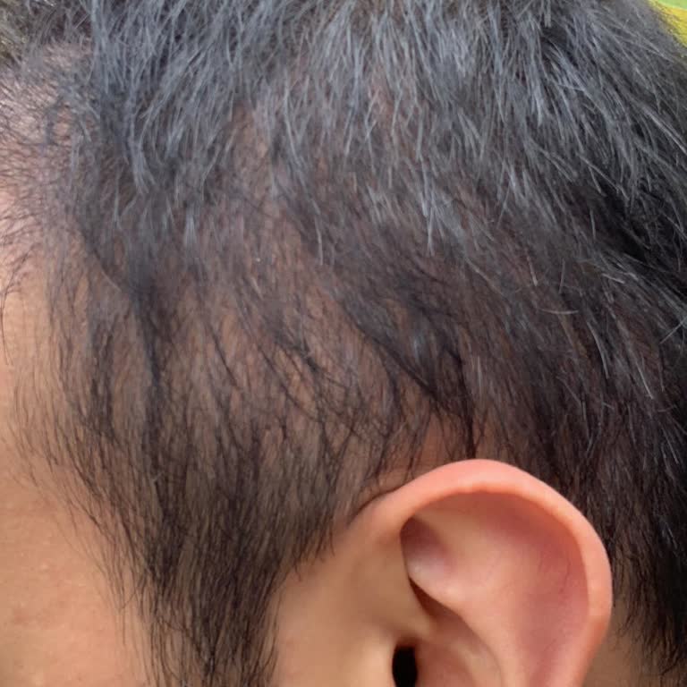 Neo Hair’da Donör Bölgesinde Aşırı Greft Alımı Sonrası Düzeltilemeyen Boşluk