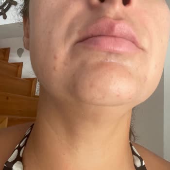 Bioderma Photoderm Spot 50 Faktör Güneş Kremi Yüzümde Şiddetli Sivilcelere Neden Oldu