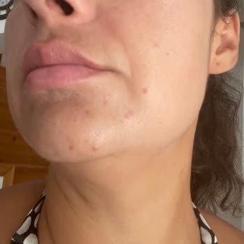 Bioderma Photoderm Spot 50 Faktör Güneş Kremi Yüzümde Şiddetli Sivilcelere Neden Oldu