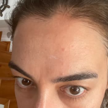 Bioderma Photoderm Spot 50 Faktör Güneş Kremi Yüzümde Şiddetli Sivilcelere Neden Oldu