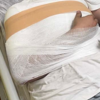 Onvo 12XPlus Ön Gidon Kırılması Nedeniyle Ağır Yaralanma Ve Yardımsız Müşteri Hizmetleri