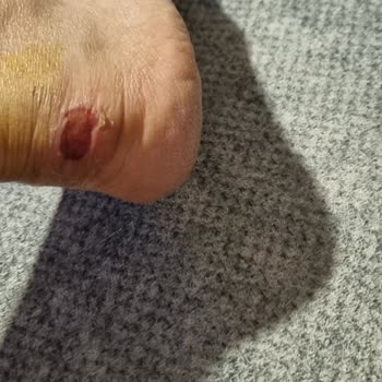 Skechers Slip-Ins Ayakkabısının Yarattığı Ağır Cilt Yaralanması Ve İlgisiz Müşteri Desteği