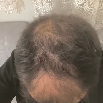 Bioxsine Forte Şampuanın Saç Dökülmesini Durdurduğu İddiaları Yanıltıcı