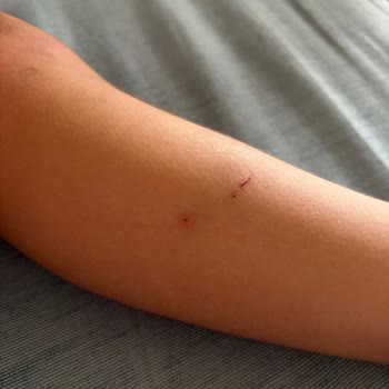 Mezitli Aquapark’ta Çocuğa Isıran Kedi Ve Yönetimin Sorumluluk Reddi