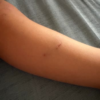 Mezitli Aquapark’ta Çocuğa Isıran Kedi Ve Yönetimin Sorumluluk Reddi
