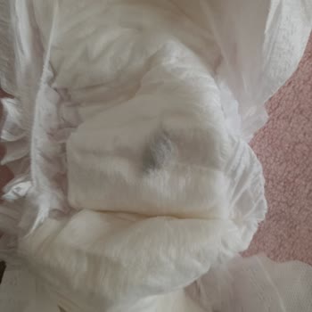 Bebek Bezinde Belirsiz Madde Ve Sağlık Endişesi