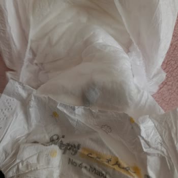 Bebek Bezinde Belirsiz Madde Ve Sağlık Endişesi
