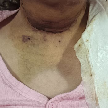 Alvin Diş Polikliniği İmplant ve Kaplama Hataları Nedeniyle Dil Kanseri Ve Sürekli Mağduriyet