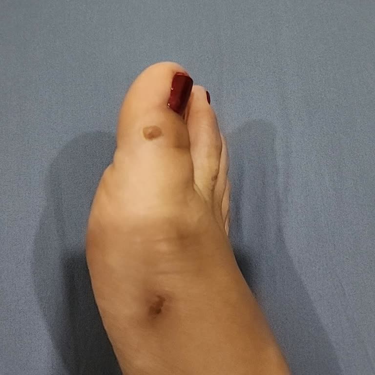 Derimod Terlik Bandı Ayağımı Kesti, Şikayetim Reddedildi