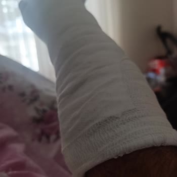 Gaz Kesilmesi Nedeniyle Kaza Ve Kol Kırığı, Garanti Redi Ve Parça Bekleyişi