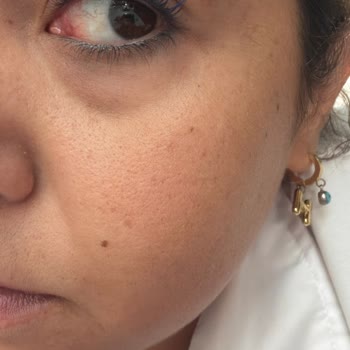 Labella Kontakt Lensinde Şiddetli Yanma Ve Değişim Talebi
