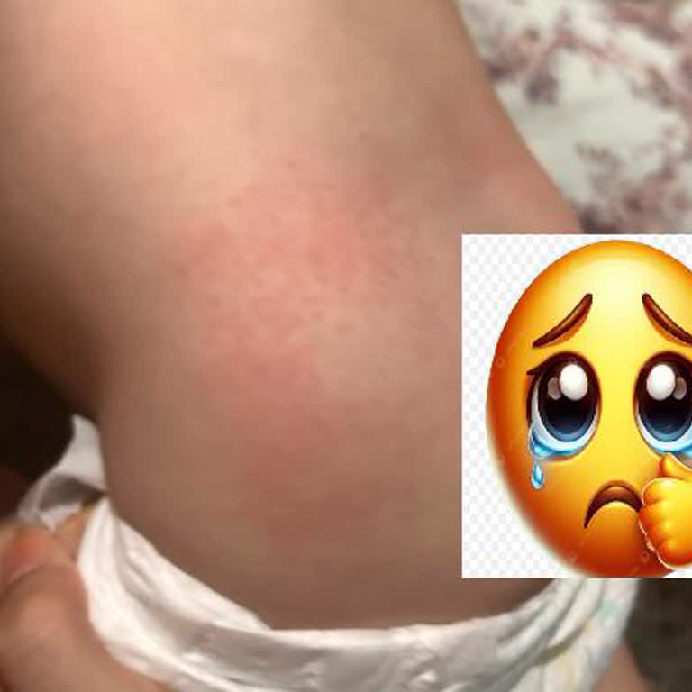 Bebekte Şiddetli Alerjik Reaksiyon Ve Bez İadesi Talebi