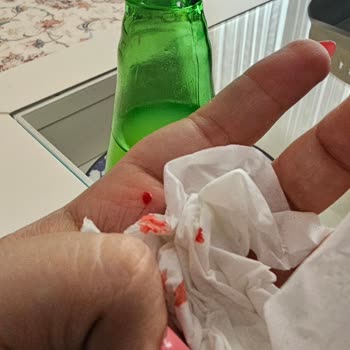 Sırma Limonlu Gazlı İçecek Şişesinin Kırık Kapağı Nedeniyle El Ve Dil Kesilmesi